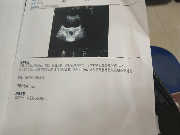 怀孕初期双胞胎B超误诊胎停的并不多