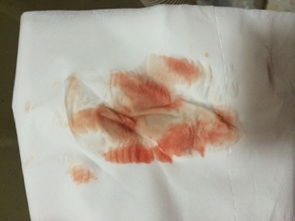 阴道出血的图片