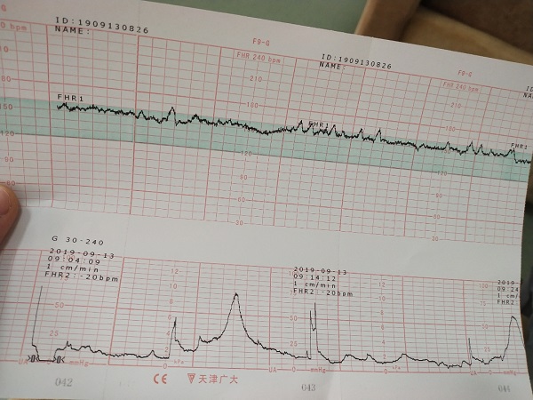 胎心监护检查的做法很简单