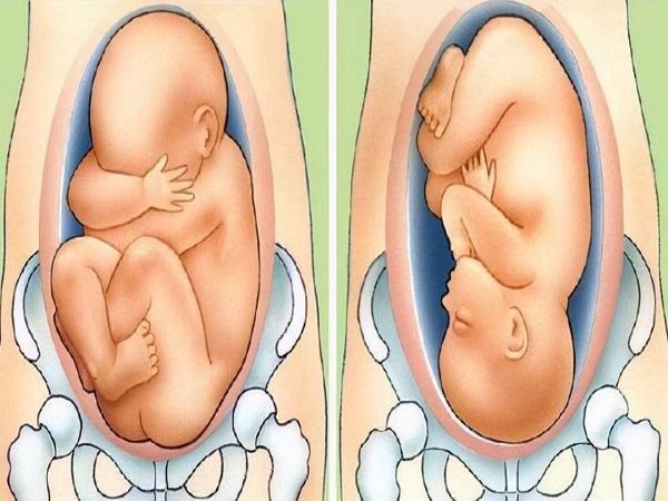胎儿头位臀位图片