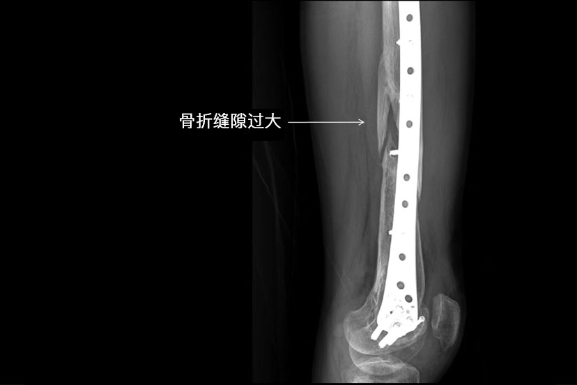 骨折手术后照片发现缝隙太大