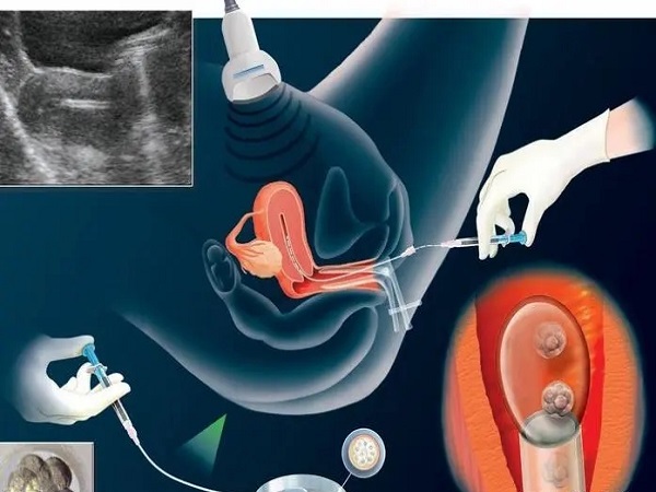 试管取卵手术过程图