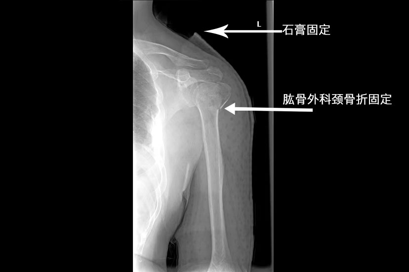 肱骨外科颈骨折石膏固定图