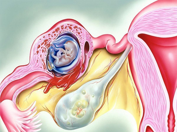 宫外孕就是受精卵着床在子宫以外的位置