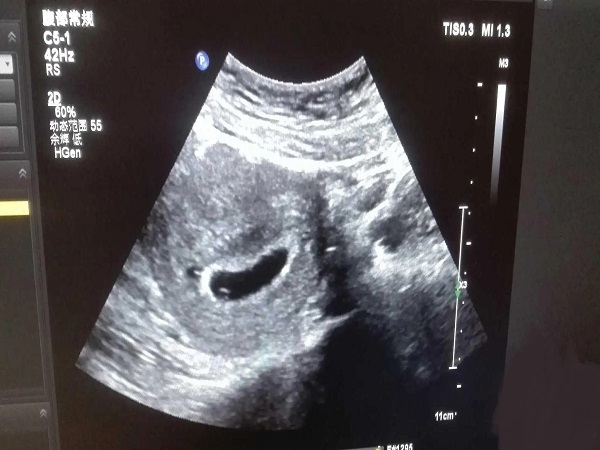 胚芽在孕7-8周的时候就可以通过B超看见