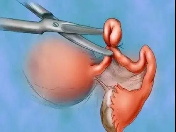 输卵管复通手术对患者年龄没有限制