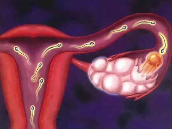 多囊卵巢是常见的妇科疾病