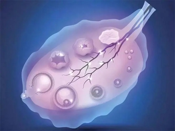 多囊卵巢中有很多排不出去的小卵泡
