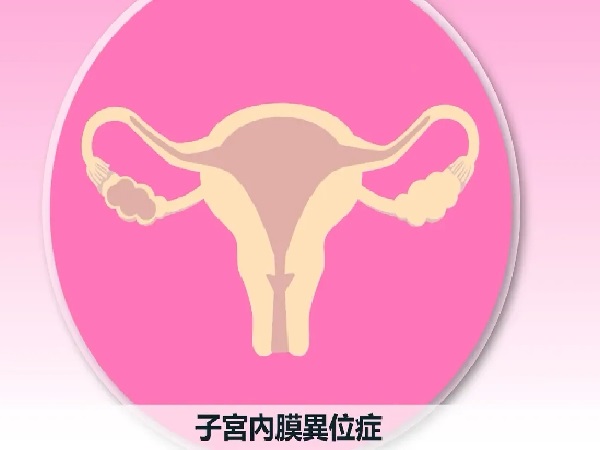 子宫内膜异位症会影响女性生育