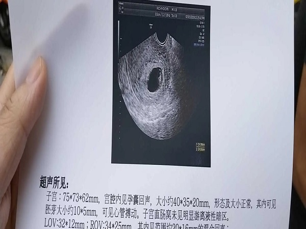 孕囊长条状的是男宝宝可能性大