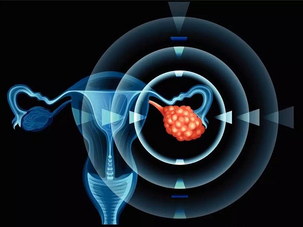 多囊卵巢是比较常见的妇科疾病