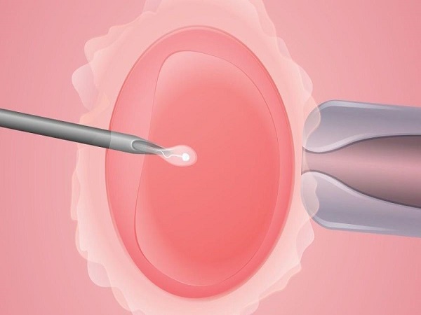 试管婴儿短方案适合卵巢反应差的患者