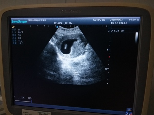 怀孕20天孕囊图片图片