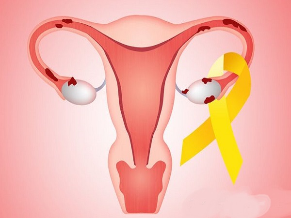 子宫内膜异位症是常见的妇科疾病