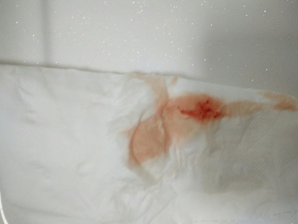 胚胎移植后有淡红色血是正常的
