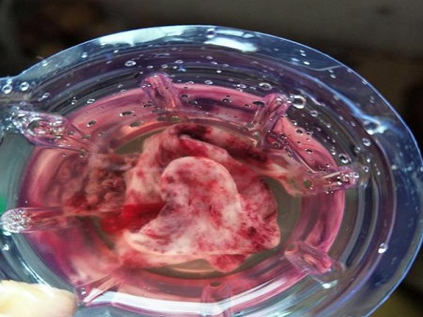 鲜胚移植13天后出血有可能是生化