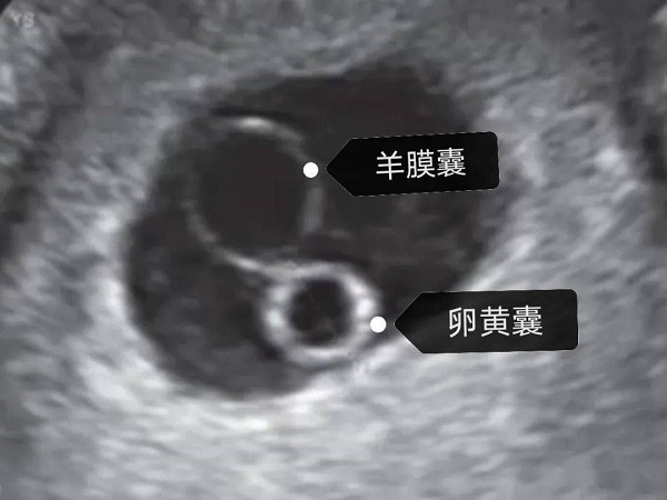 囊胚移植35天孕囊小是不正常的