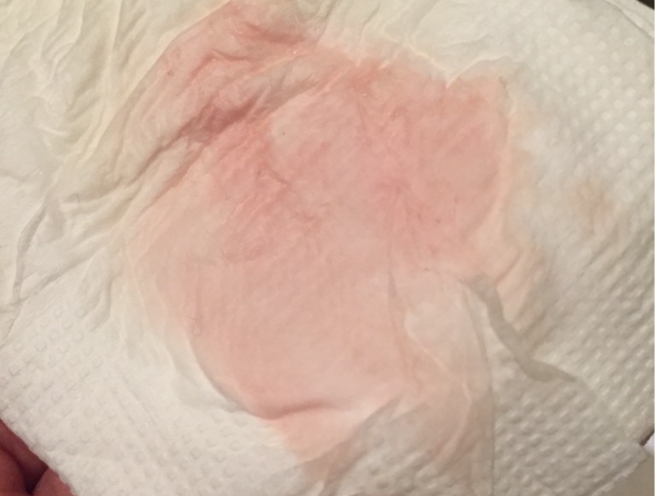 冻胚移植后出现粉色分泌物可能是阴道出血