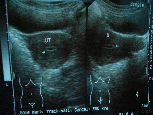 囊胚移植后有少量积液是正常的