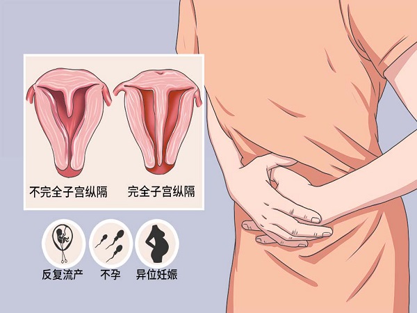 子宫纵膈是比较常见的女性生殖道畸形