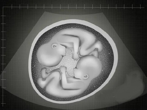 一超一个孕囊二超双胎可能是胚胎分裂导致的
