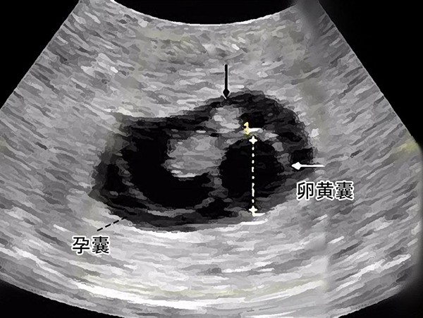 孕五周看见孕囊内卵黄囊的概率比较小