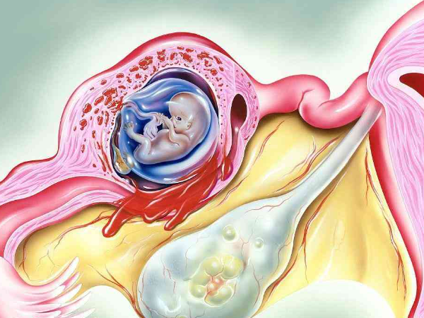 间质部妊娠属于输卵管妊娠