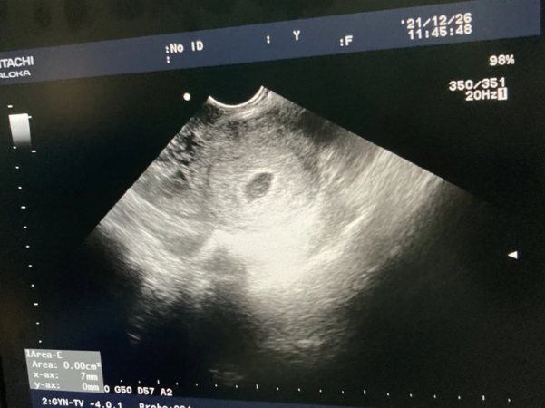 双胚移植显示一个孕囊说明只有一个胚胎着床成功