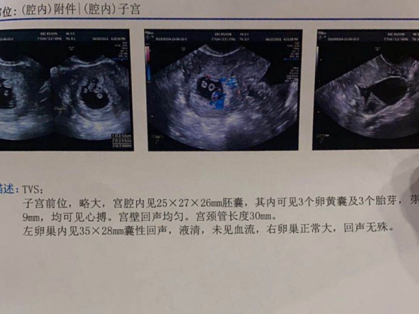 试管一个囊胚分成三个胚胎需要先减胎后保胎