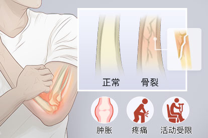 轻微骨裂是什么症状图片