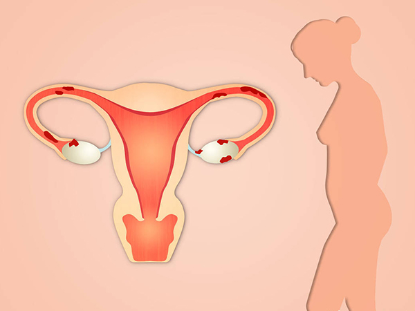 输卵管堵塞对影响正常怀孕