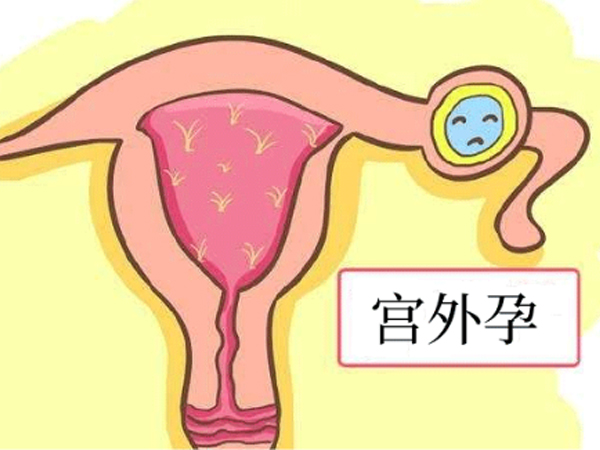 试管宫外孕需要及时治疗