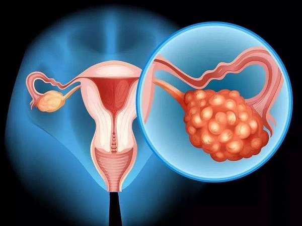 内膜异位症会影响怀孕