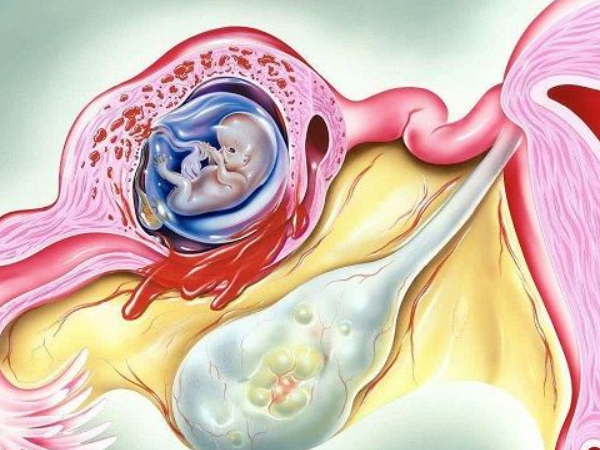 试管移植后可能会出现宫外孕