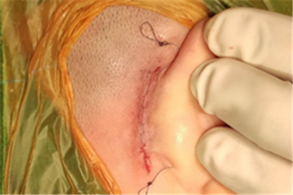 人工耳蜗体内植入体部分