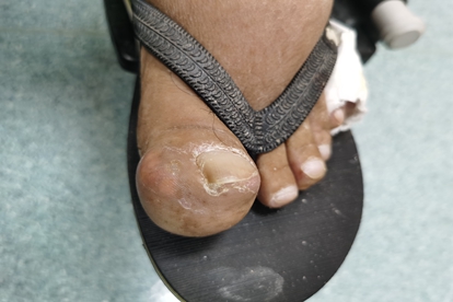 风湿脚趾疼痛位置