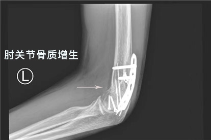 肘关节骨质增生图片