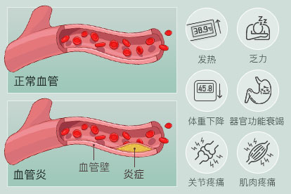 血管炎症状