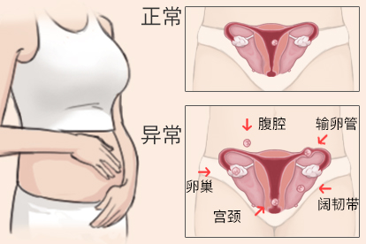 异位妊娠的部位