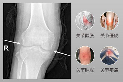 骨关节炎症状图片