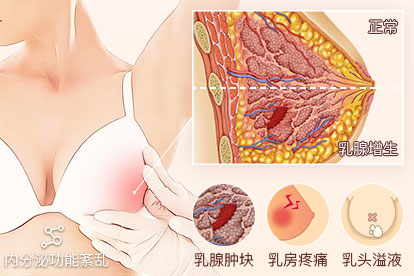 乳腺增生的原因和症状