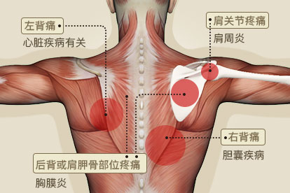 背肩部疼痛部位对应疾病图