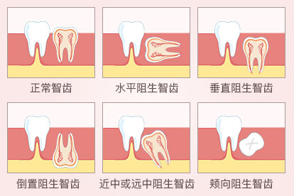 智齿的常见类型图片