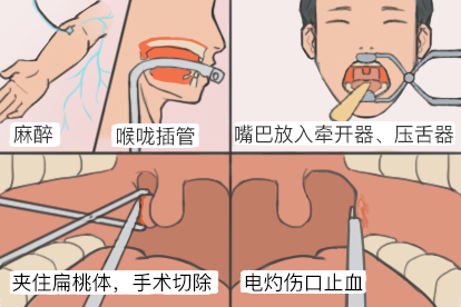 扁桃体手术切除图片