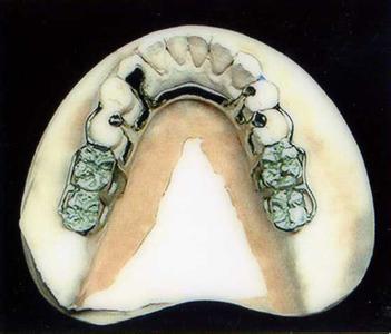 铸造支架活动义齿图片