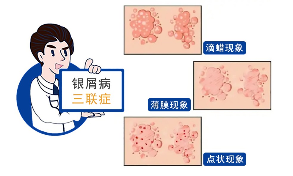 银屑病和玫瑰糠疹和湿疹的区别 南京银屑病专家在线问诊