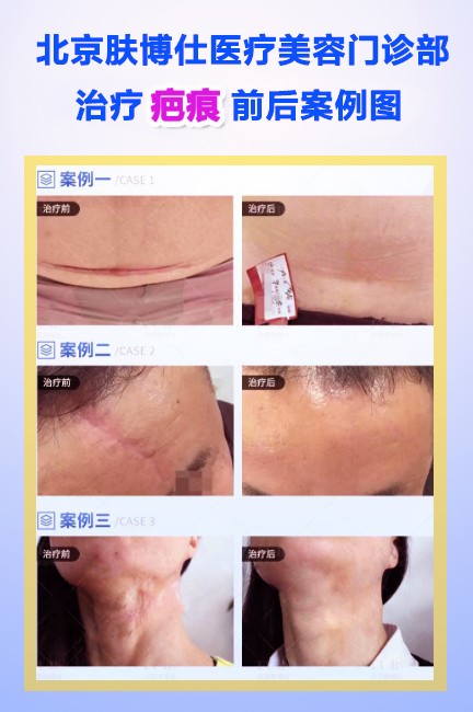 北京疤痕治疗的优选医院：肤博仕医疗美容门诊部