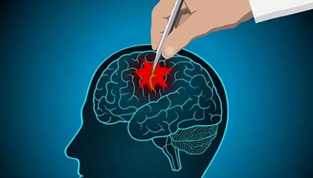 武汉癫痫病医院在线预约挂号-为什么有的癫痫发作后会头痛？