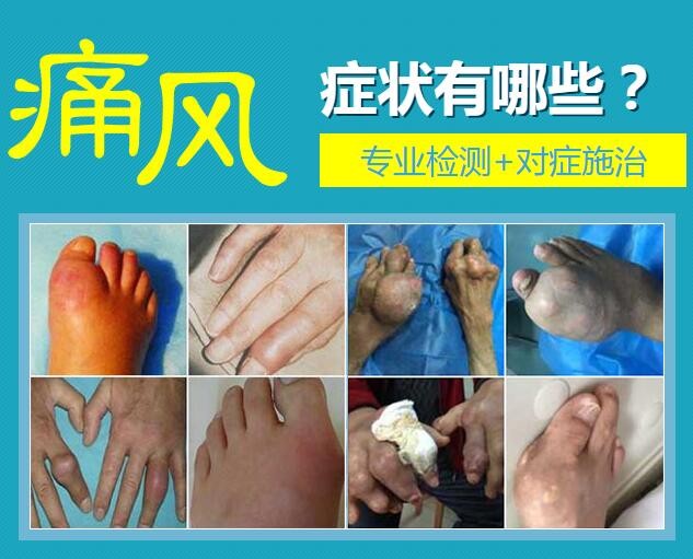 郑州痛风医院医生：痛风疼痛等级在临床上可分为四个阶段!