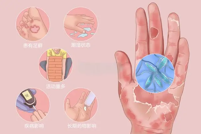上海治疗皮肤病去什么医院-什么因素会使手癣恶化
